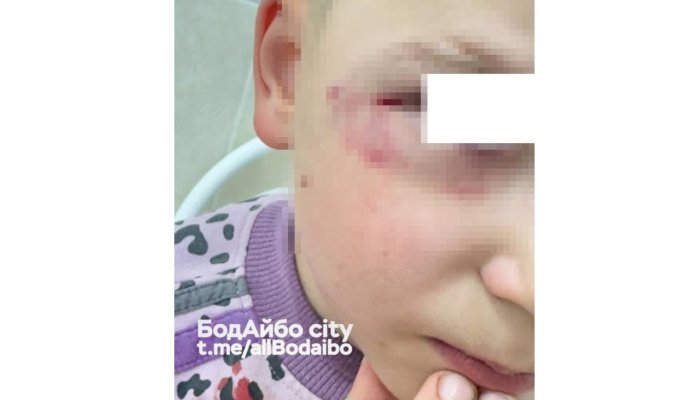 В Бодайбо собака покусала ребенка за лицо