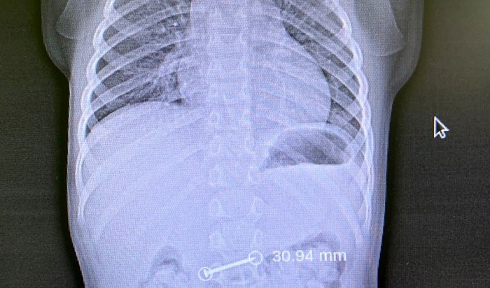 Иркутские врачи достали из пищевода ребенка строительный крючок