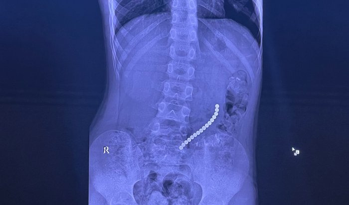 В Иркутске врачи прооперировали ребенка, проглотившего 16 магнитов