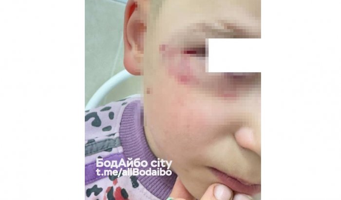 В Бодайбо собака покусала ребенка за лицо