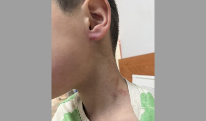 Сотрудник детсада в Иркутском районе нанес травмы воспитаннику