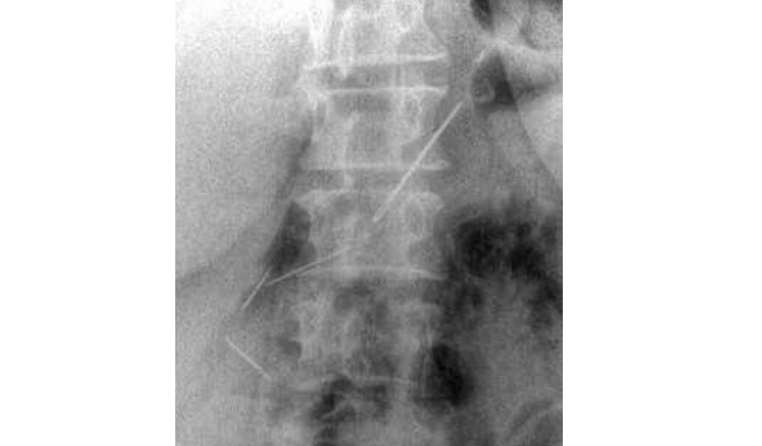 В Подмосковье врачи извлекли четыре швейные иглы из живота пенсионерки