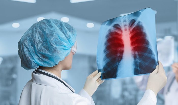 В 2022 году в Приангарье выросла заболеваемость туберкулезом